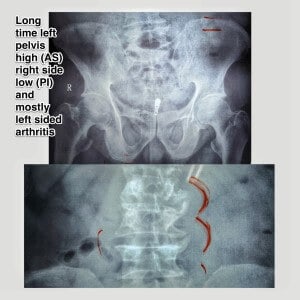 Degeneration of the spine is clearly visible