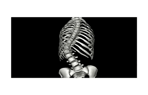 Adult Elderly Scoliosis Treatment 14 Spinal curvature MRI highlighting scoliosis, with an abnormal sideways curve of the spine affecting posture and health.