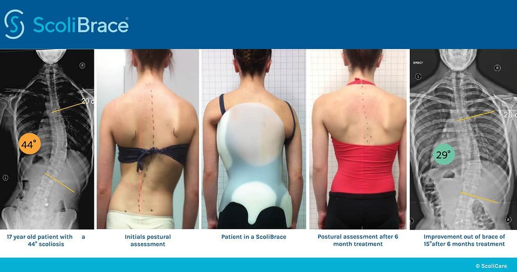 Superior in-brace correction achieved with a ScoliBrace