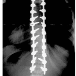 Figure 4: Surgery for AIS