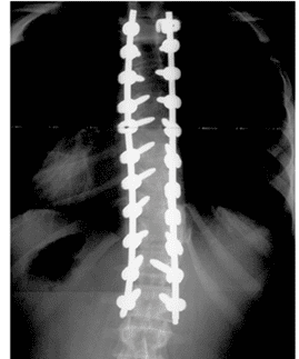 fused spine