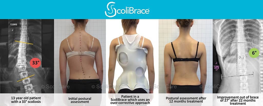 Why Refer To Scoliosis Center of LA 16 Advanced scoliosis correction with ScoliBrace for improved spine alignment and posture.