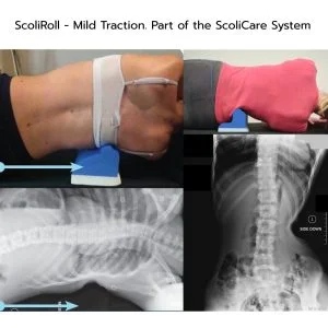 Adult Elderly Scoliosis Treatment 2 scoliroll thoracic and xray demo