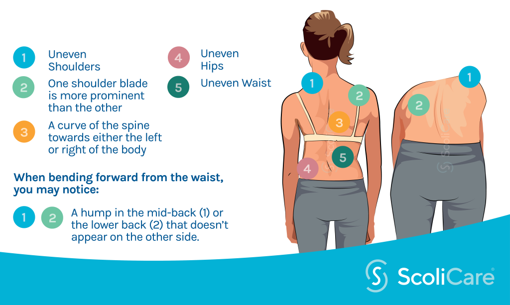 signs to look for scoliosis