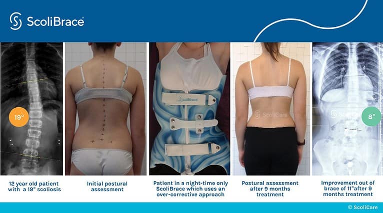 Scoliosis Brace Options & Scoliosis Bracing Alternatives