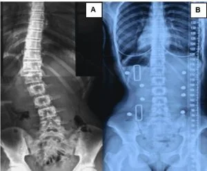 X-ray images showing scoliosis before and after chiropractic treatment at Scoliosis Center of LA & Chiropractic.