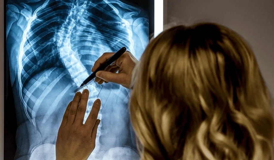 Getting Ahead of the Curve: The Importance of Early Scoliosis Detection - for patients 1 xray view