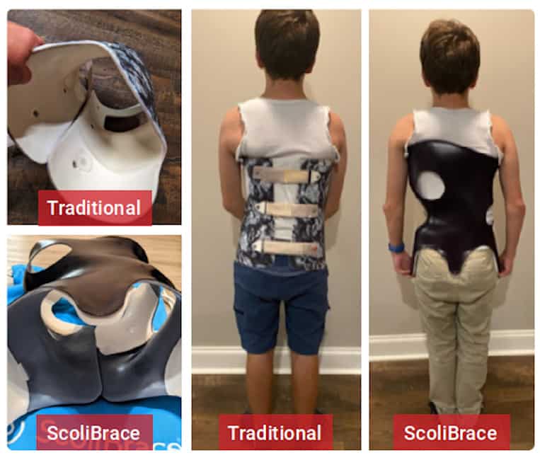 Proposed scoliosis brace on patient: (a) front and (b) back