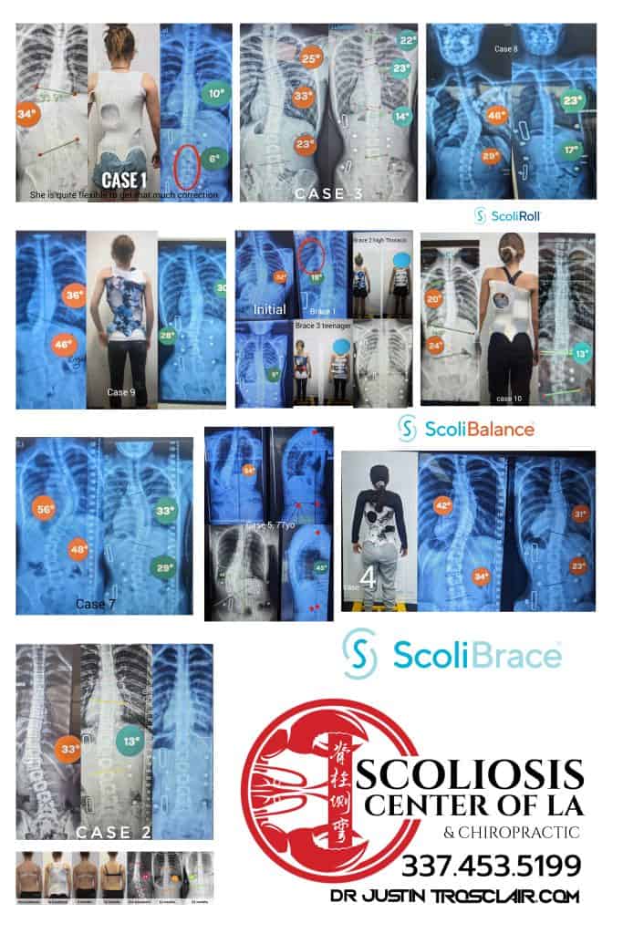 ScoliBalance Scoliosis Exercises 17 X-ray images showing various scoliosis cases with curvature measurements, spinal alignments, and chiropractic treatment stages at Scoliosis Center of LA & Chiropractic.