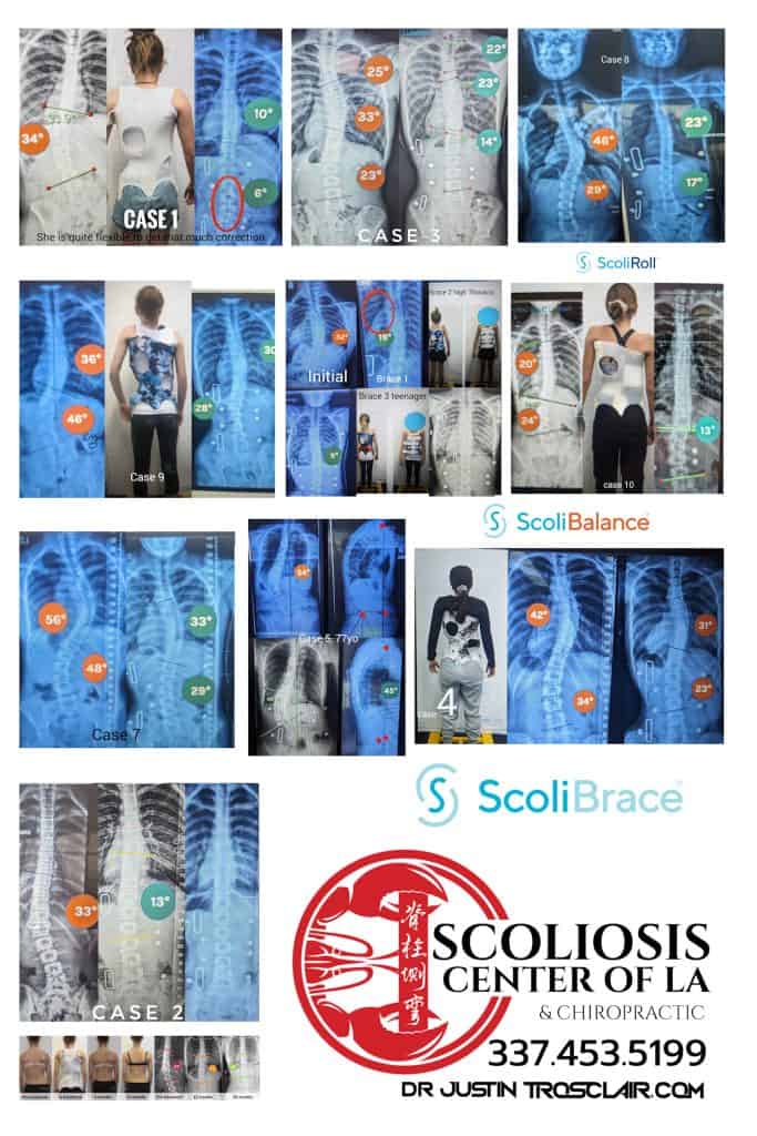 ScoliBrace 3d Custom Bracing 15 X-ray images showing various cases of scoliosis and spinal misalignment treated effectively at the Scoliosis Center of LA & Chiropractic.