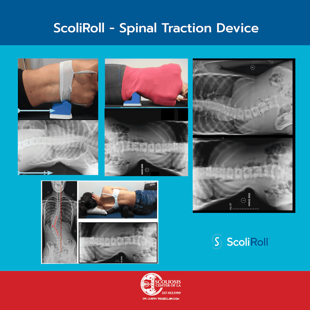 Why Refer To Scoliosis Center of LA 8 Minimally invasive scoliosis treatment using the ScoliRoll spinal traction device to correct spinal curvature.