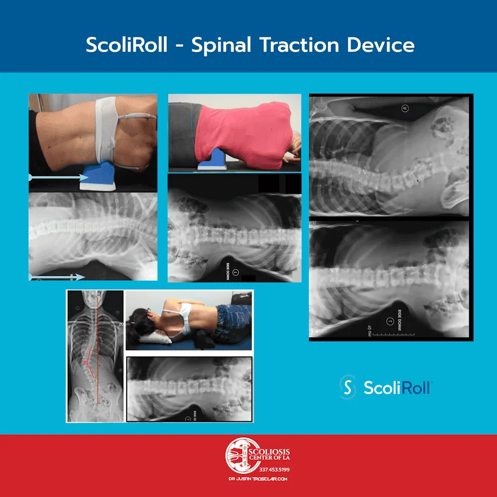 Minimally invasive scoliosis treatment using the ScoliRoll spinal traction device to correct spinal curvature.