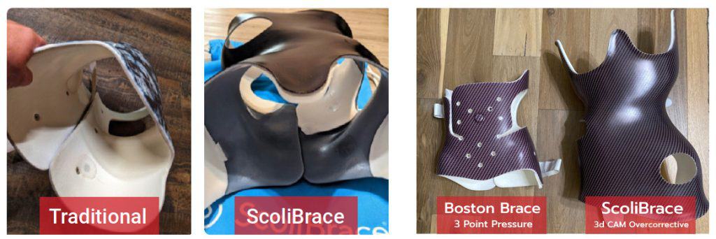 ScoliBrace 3d Custom Bracing 14 Traditional scoliosis brace model for spinal correction and treatment.