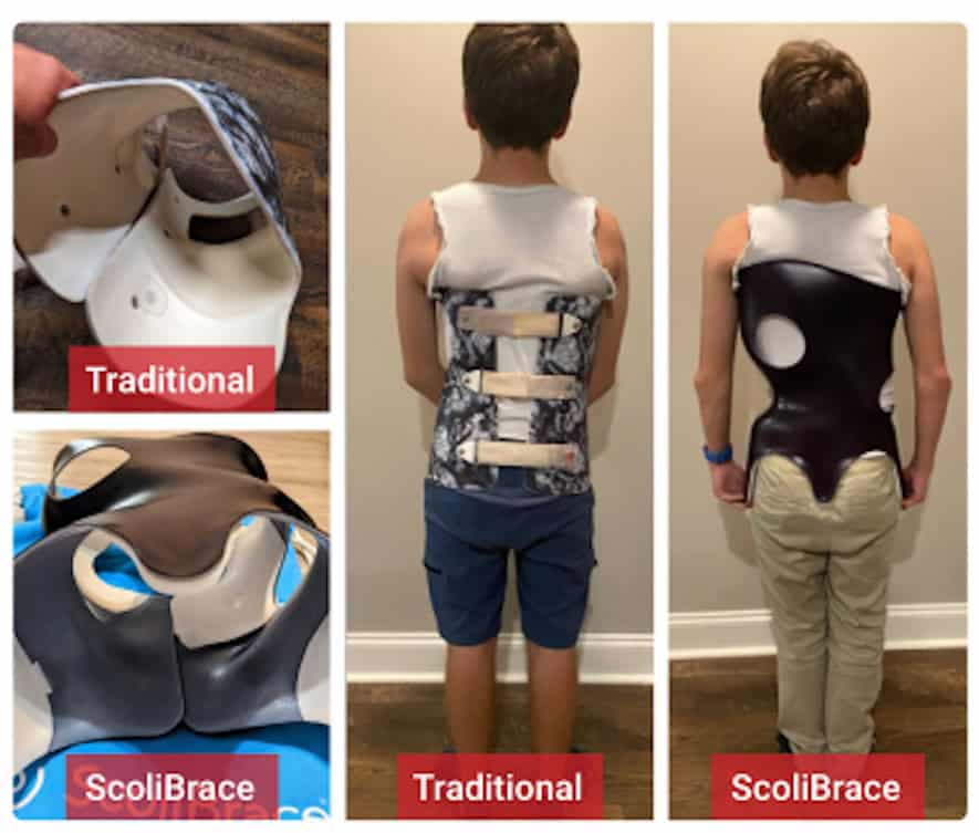 Why Refer To Scoliosis Center of LA 11 ScoliBrace spinal brace used for scoliosis correction in children, showing a before and after transformation at the Scoliosis Center of LA & Chiropractic.