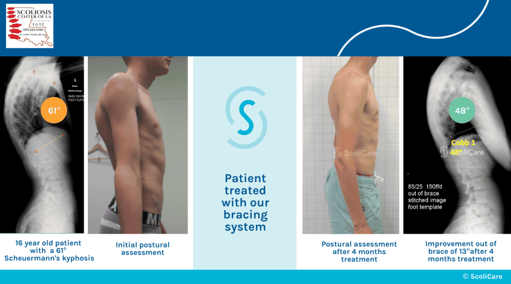 ScoliBrace 3d Custom Bracing 22 Scoliosis Center of LA & Chiropractic specializes in diagnosing and treating scoliosis with advanced bracing and chiropractic care for patients of all ages.