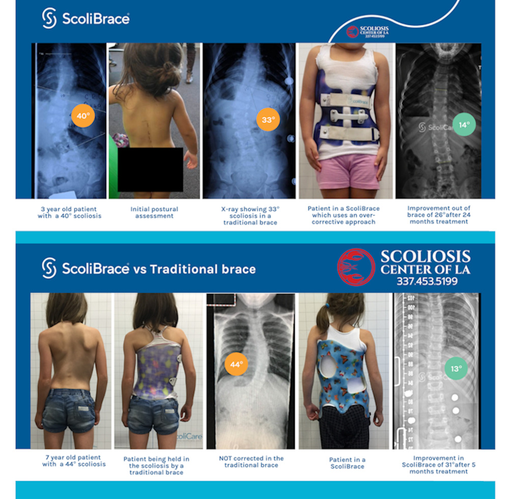 Why Refer To Scoliosis Center of LA 2 b and a 1