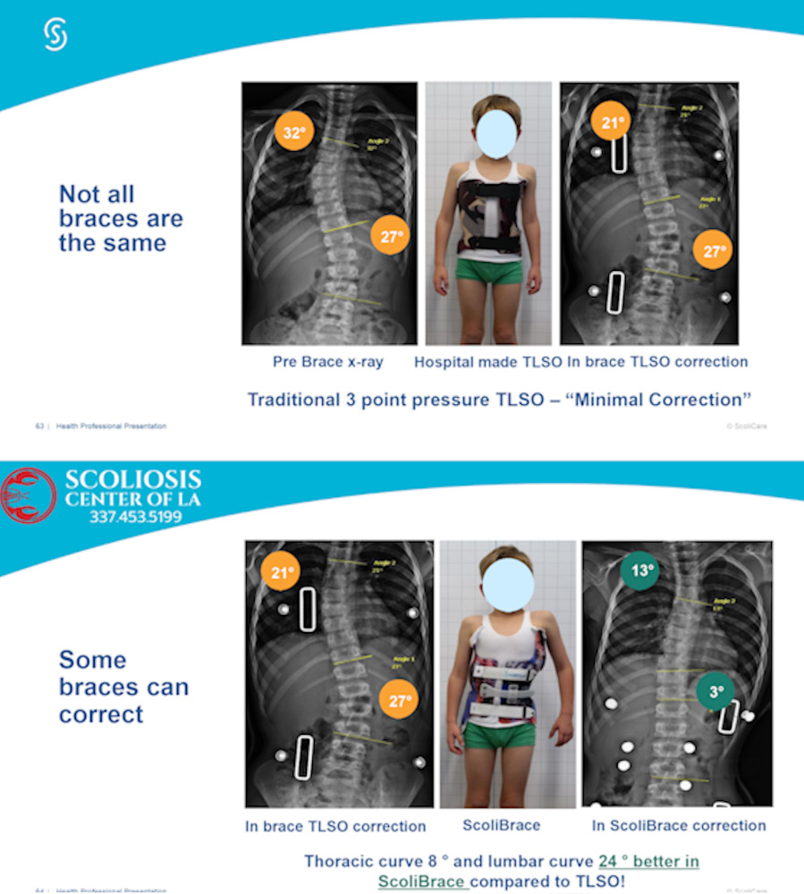 Why Refer To Scoliosis Center of LA 10 b and a