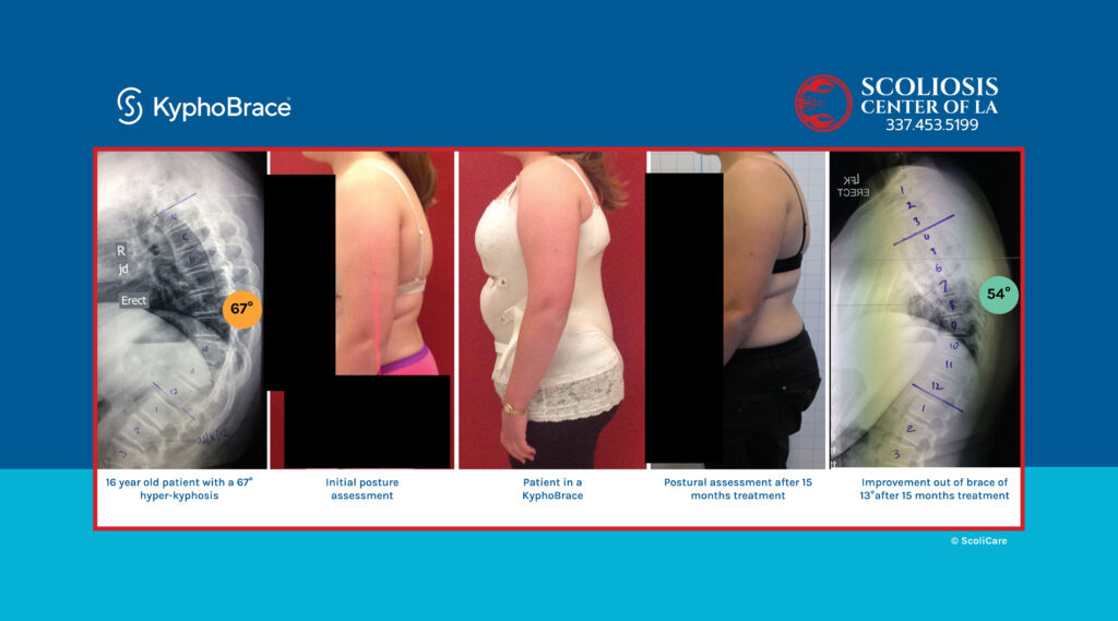 fb Hyper kyphosis old person KyphoBrace large