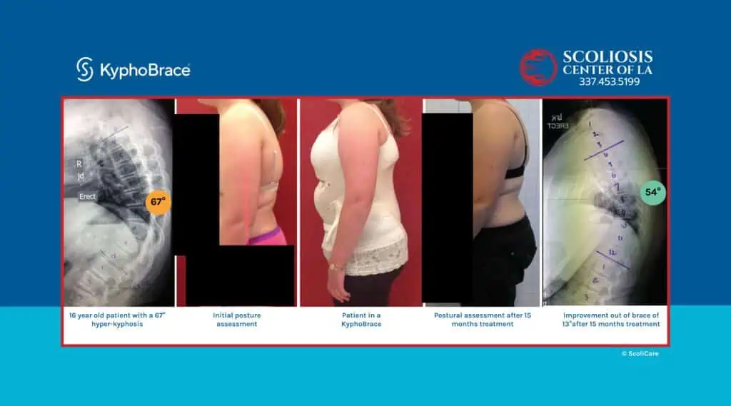 HyperKyphosis Treatment 16 Progression of kyphosis and scoliosis treatment showing X-ray, posture, and brace improvements at Scoliosis Center of LA.