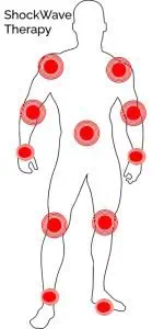 Diagram showing key areas for scoliosis taping including shoulders, back, hips, knees, and ankles for scoliosis treatment and support.