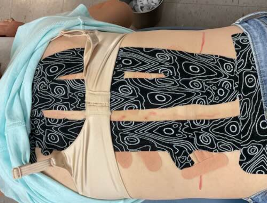 ScoliBrace 3d Custom Bracing 32 Application of German scoliosis taping technique on a patient's back to support spinal alignment and reduce curvature.