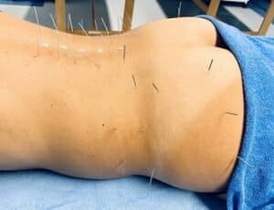 Acupuncture needles inserted along the back for scoliosis treatment at Dr. Justin Introsclair's Scoliosis Center of LA.
