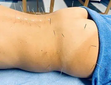 Dry Needling for Scoliosis: Why Muscles Matter as Much as the Curve 2 Acupuncture needles inserted along the back for scoliosis treatment at Dr. Justin Introsclair's Scoliosis Center of LA.