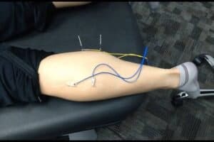 Why Your Pain Keeps Coming Back (And the Tender Spot Nobody Told You About) 3 Patient undergoing spinal decompression therapy with medical devices attached to the leg for pain relief and scoliosis treatment.