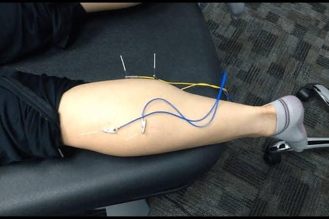 Why Your Pain Keeps Coming Back (And the Tender Spot Nobody Told You About) 1 Patient undergoing dry needling therapy with medical devices attached to the leg for pain relief and scoliosis treatment.