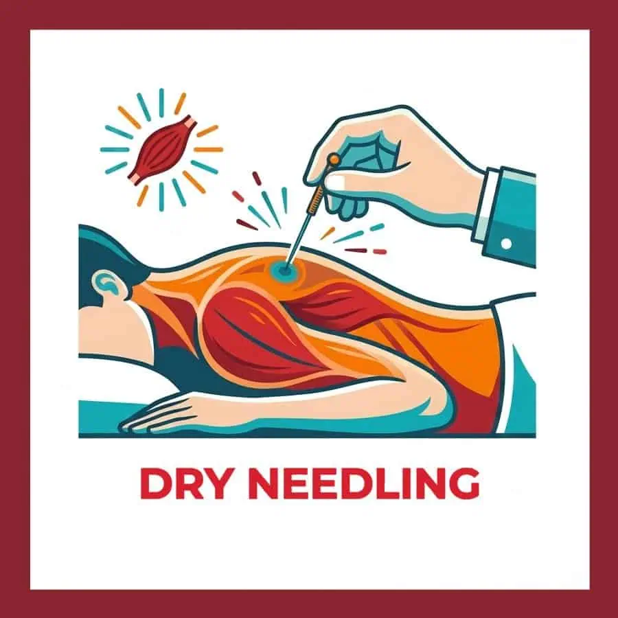 Services 3 Illustration of dry needling therapy targeting muscle pain in the back, used for pain relief and muscle relaxation.