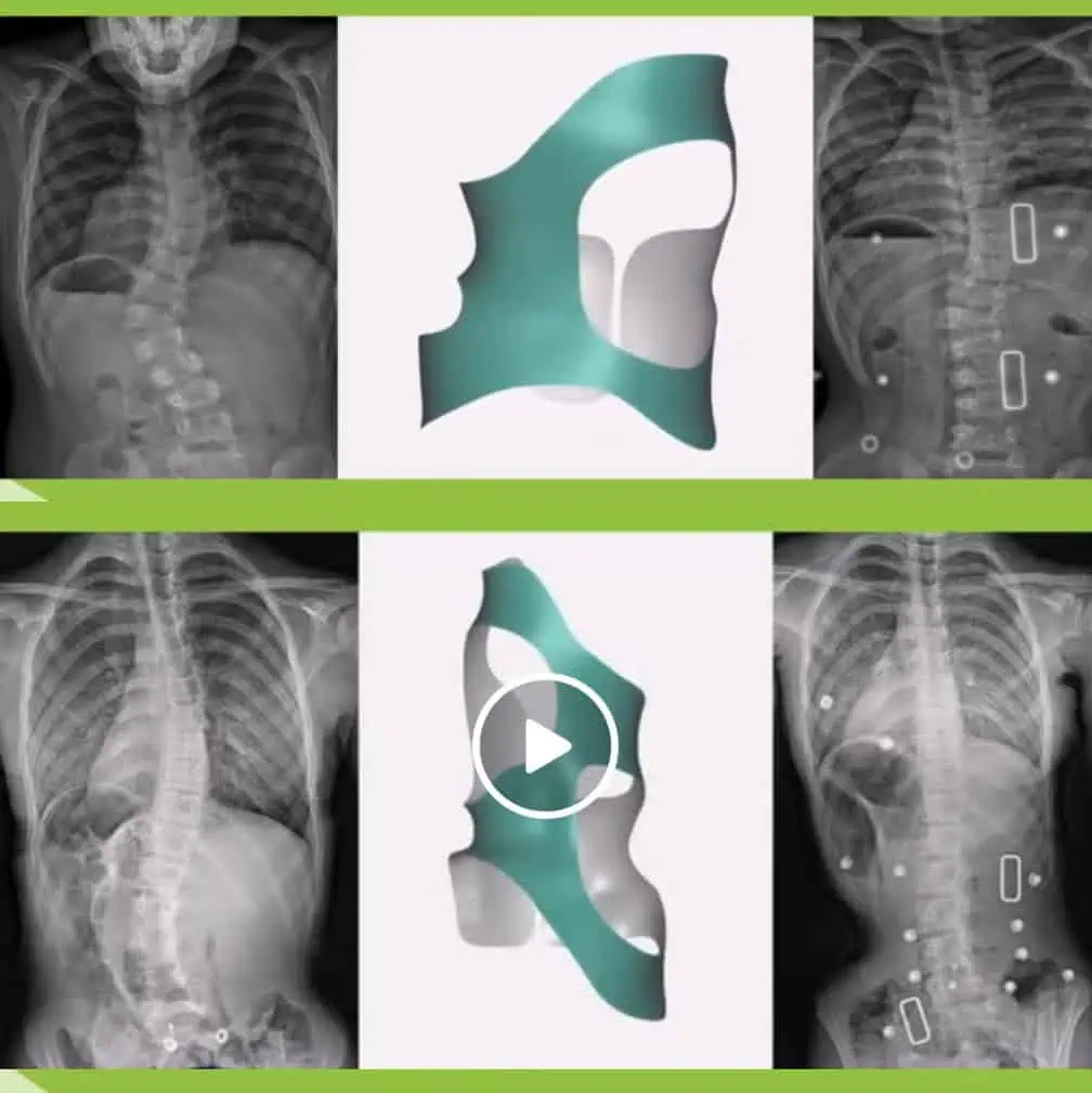 X-ray images of scoliosis spine with correction illustration and treatment options at Scoliosis Center of LA.