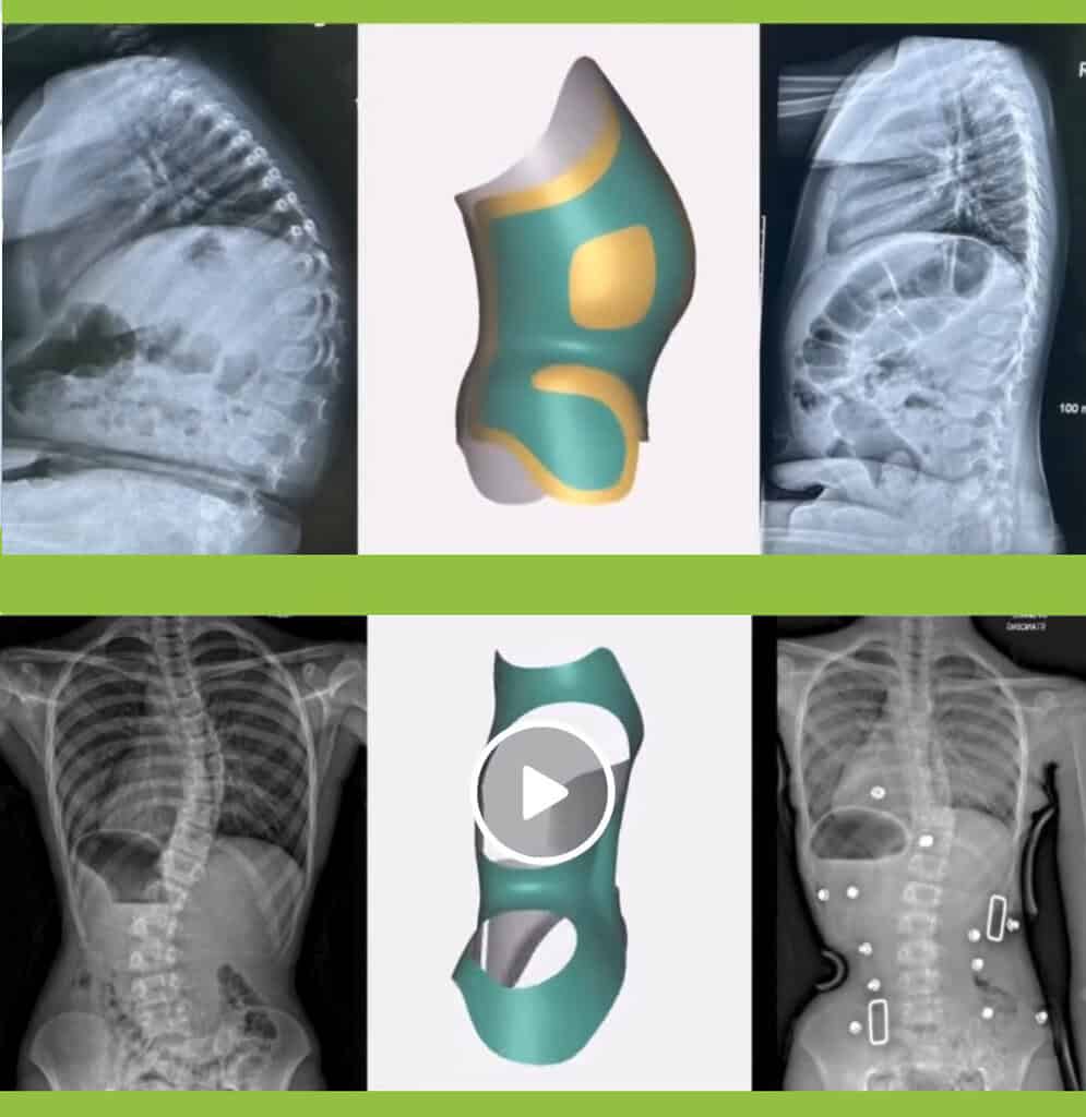 CMP Brace for Scoliosis 5 Before and after X-ray showing scoliosis curve correction with the CMP Brace
