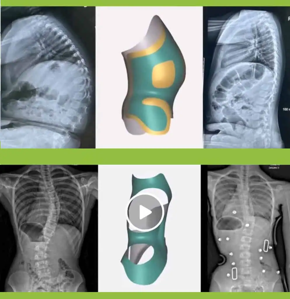 X-ray images of scoliosis spine with custom scoliosis brace design and 3D modeling for treatment planning.