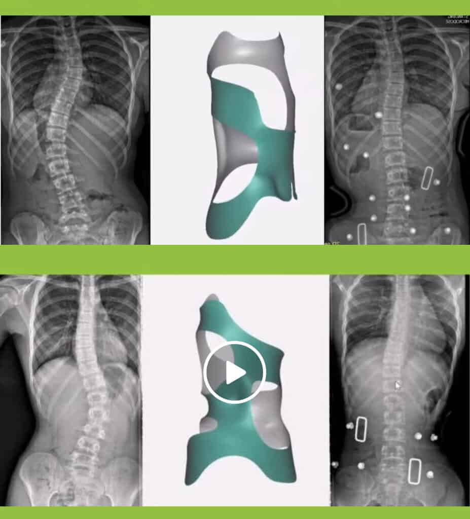 CMP Brace for Scoliosis 6 Before and after X-ray showing scoliosis curve correction with the CMP Brace