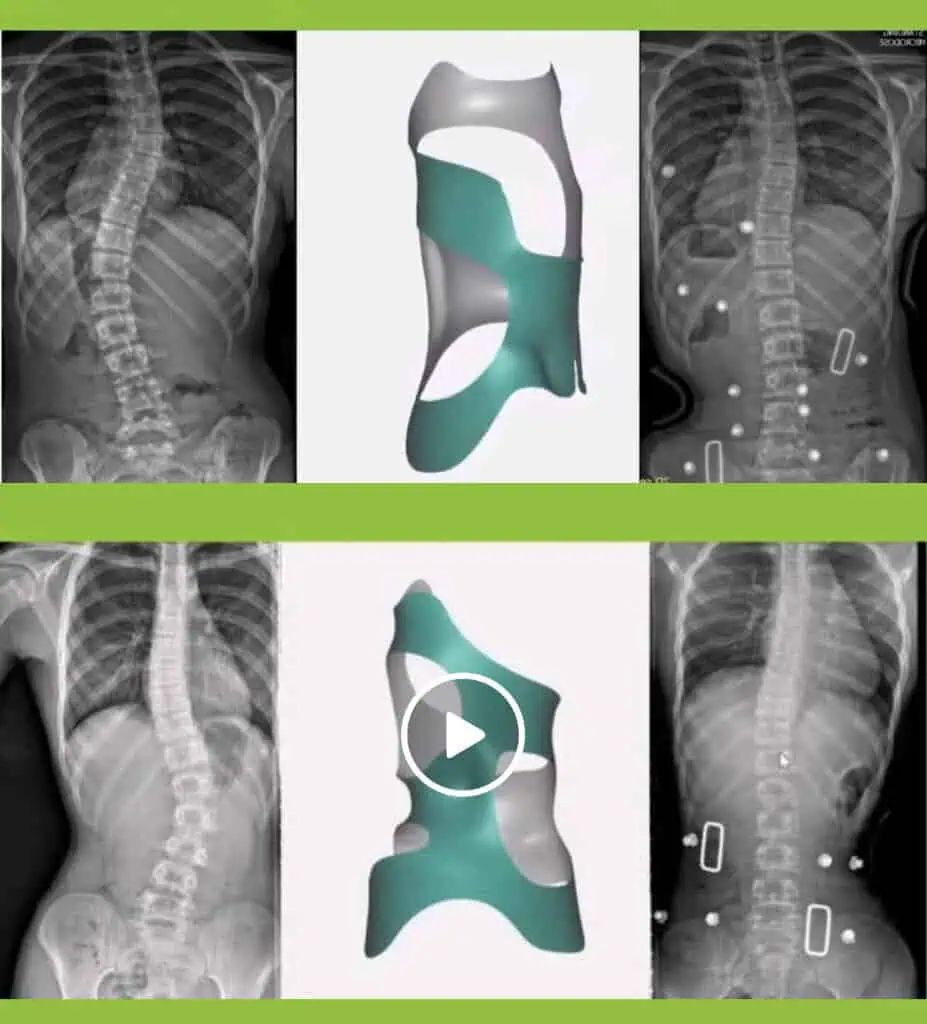 Before and after X-ray showing scoliosis curve correction with the CMP Brace