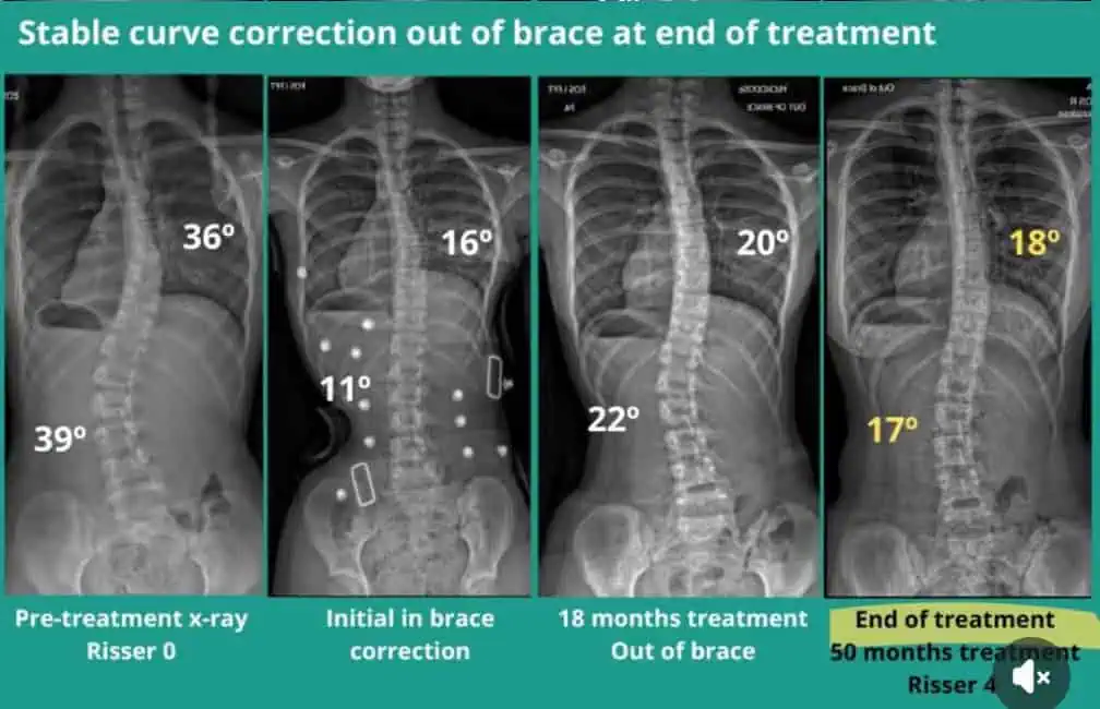 X-ray images showing scoliosis curve correction over treatment stages at Dr. Justin's Scoliosis Center of LA.