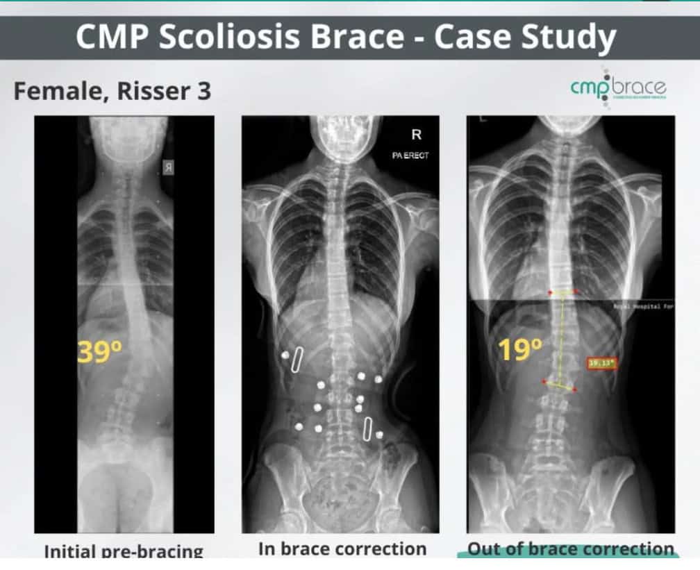 CMP Brace for Scoliosis 10 Before and after X-ray showing scoliosis curve correction with the CMP Brace