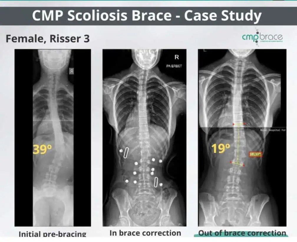 X-ray images showing scoliosis correction with brace, initial pre-bracing, in brace correction, and out of brace correction, for a female patient.