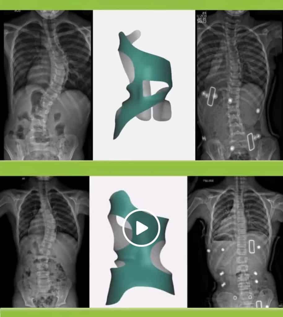 CMP Brace for Scoliosis 7 Before and after X-ray showing scoliosis curve correction with the CMP Brace