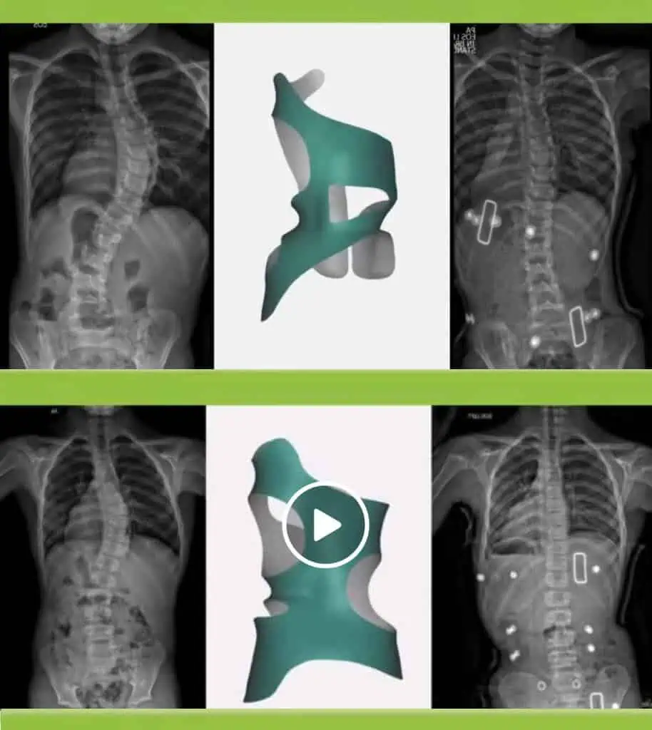 Before and after X-ray showing scoliosis curve correction with the CMP Brace