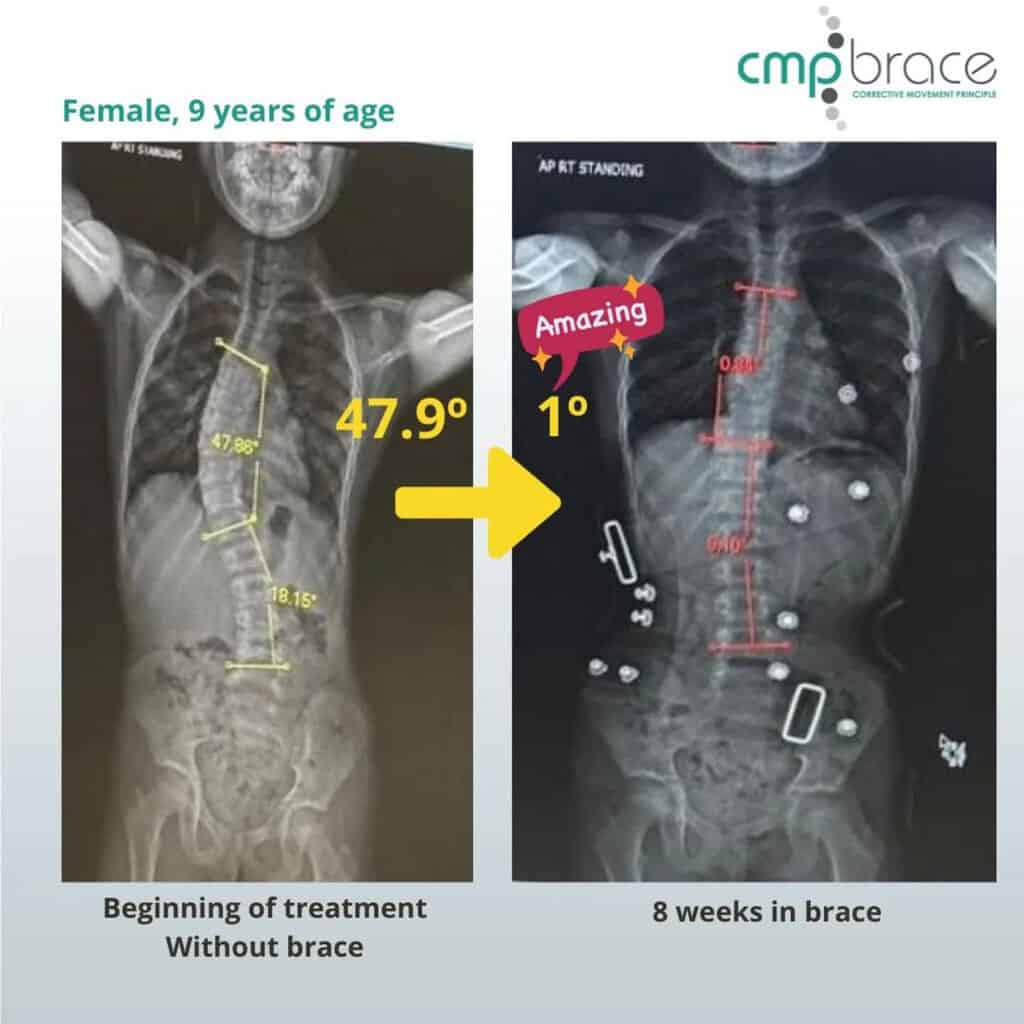 CMP Brace for Scoliosis 11 Before and after X-ray showing scoliosis curve correction with the CMP Brace