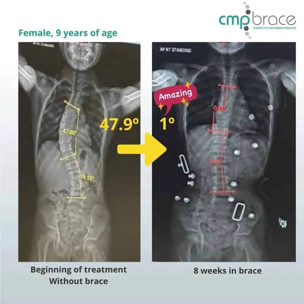 X-ray images showing scoliosis correction in a 9-year-old girl before and after 8 weeks of brace treatment at the Scoliosis Center of LA.