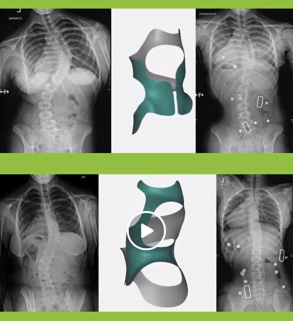 CMP Brace for Scoliosis 8 Before and after X-ray showing scoliosis curve correction with the CMP Brace