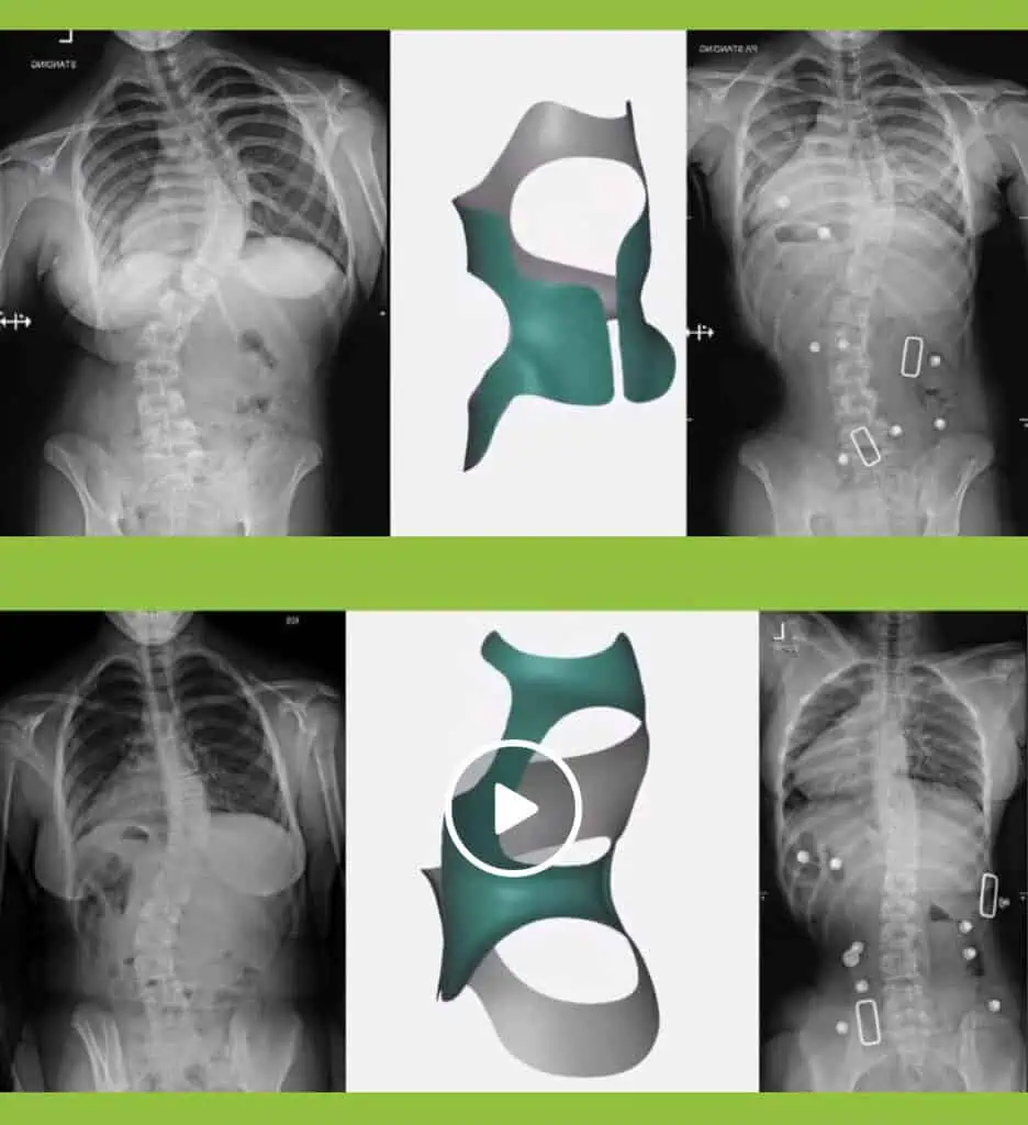 Before and after X-ray showing scoliosis curve correction with the CMP Brace