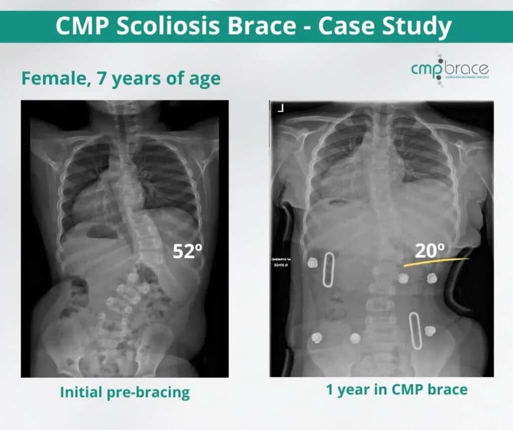 CMP Brace for Scoliosis 3 Before and after X-ray showing scoliosis curve correction with the CMP Brace