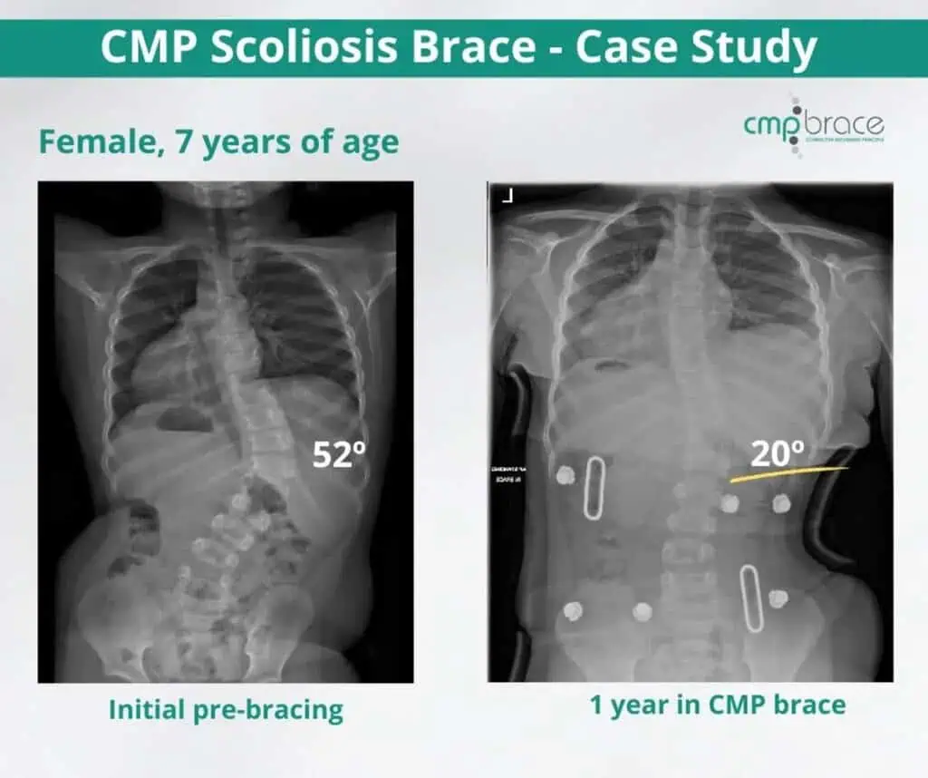 X-ray images showing scoliosis correction in a 7-year-old girl before and after one year of brace treatment at CMP Scoliosis Center.