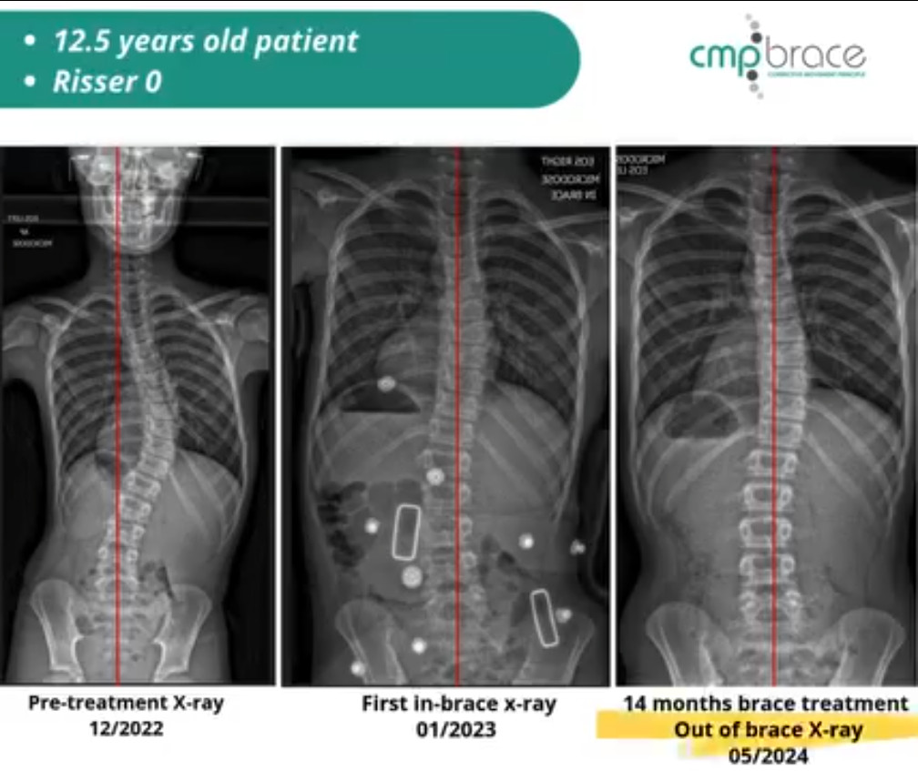 CMP Brace for Scoliosis 1 Before and after X-ray showing scoliosis curve correction with the CMP Brace