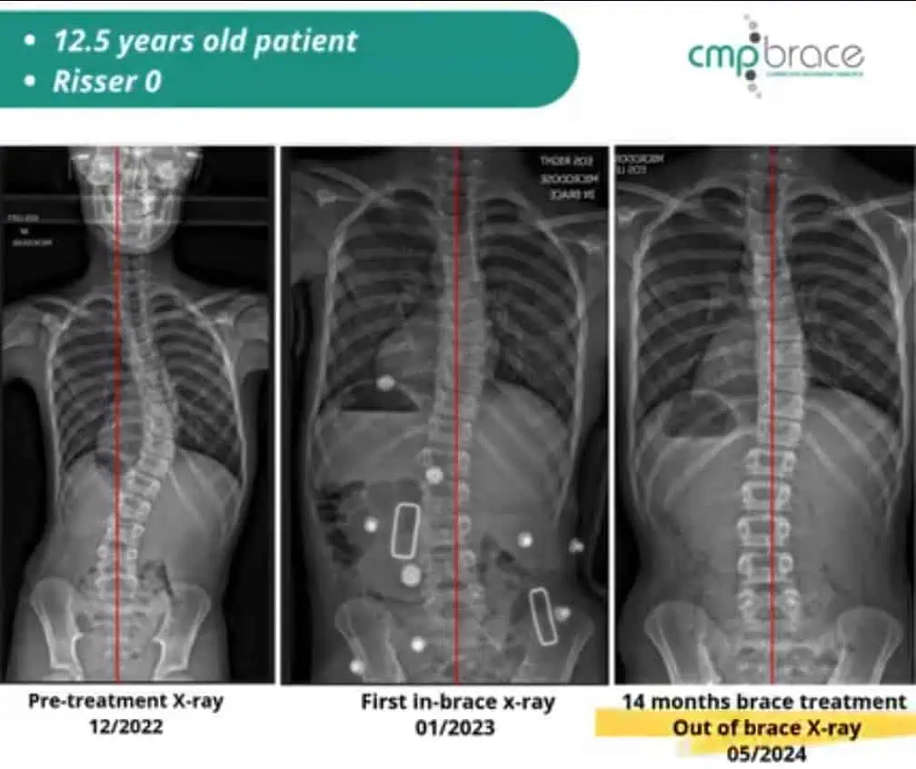 X-ray images showing scoliosis progression in a 12.5-year-old patient over 14 months of treatment at the Scoliosis Center of LA.
