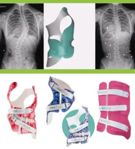X-ray images and scoliosis braces showcasing treatment options at the Scoliosis Center of LA and Chiropractic.