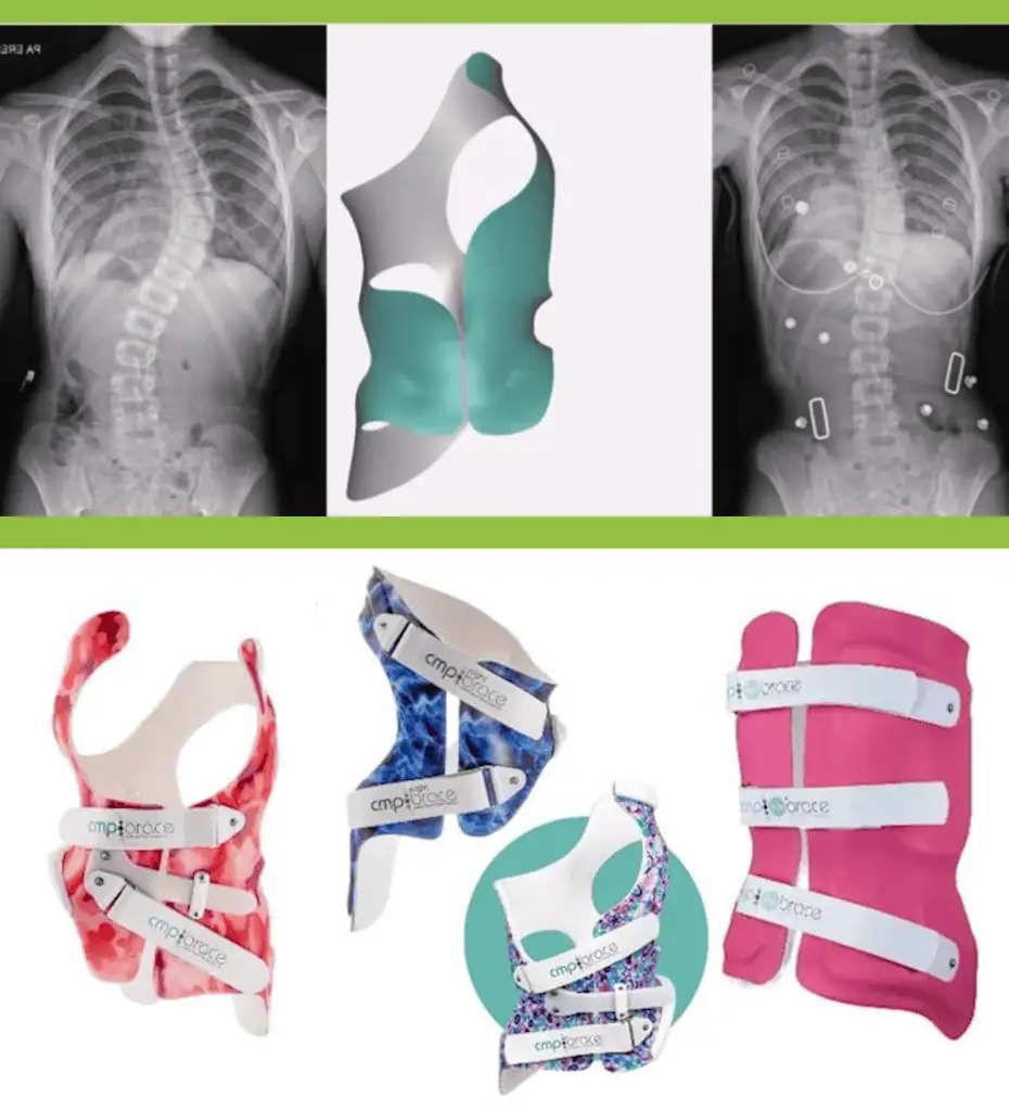 X-ray images and scoliosis braces showcasing treatment options at the Scoliosis Center of LA and Chiropractic.
